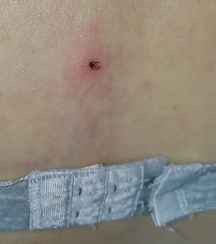 Aargh! Had ik toch een teek! 1 teek opde rug