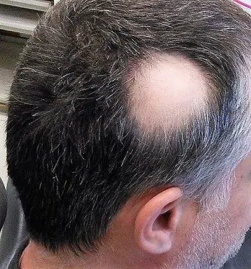 Alopecia: Help ik word kaal - het verhaal van Barbara 3 512px Alopecia areata 1