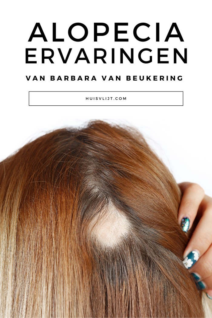 alopecia ervaringen