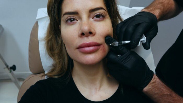 misslukt botox